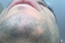 Sakal Kıran Belirtileri ve Tedavisi