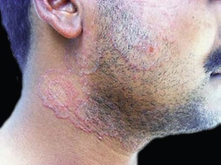 Sakal Batması Nedenleri?